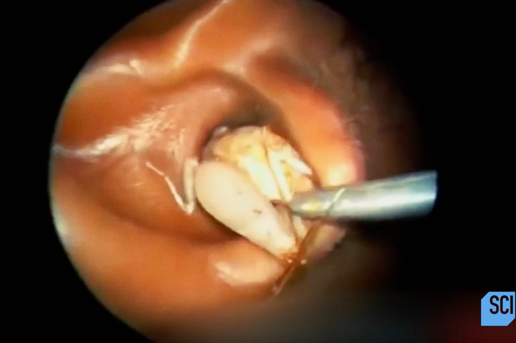 Some of the more revolting cases involved bugs in the ear.
